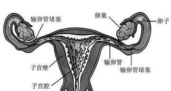 输卵管通畅检查怎么做最准确