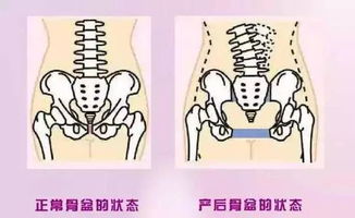 产后骨盆松弛手法复位有效吗