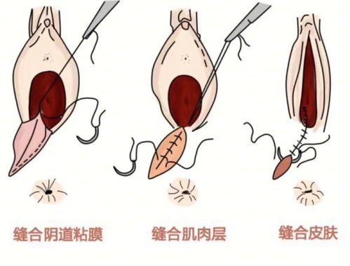 顺产撕裂伤口裂开了能自己长好愈合吗