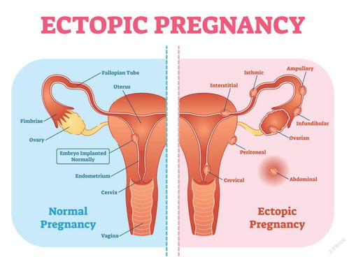 异位妊娠孕妇的护理