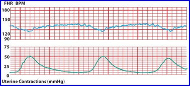 宫缩和胎心监护的区别