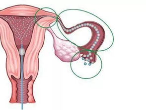 输卵管通畅度的检查方法包括