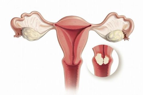 产后如何预防感染hpv