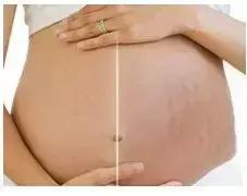 怀孕期间如何护理皮肤