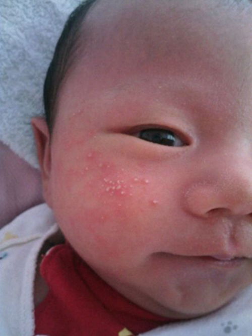 怎样预防湿疹婴儿湿疹