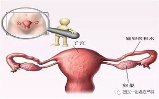 输卵管通畅性检查方法