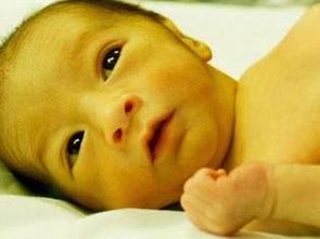 新生儿黄疸观察及护理要点
